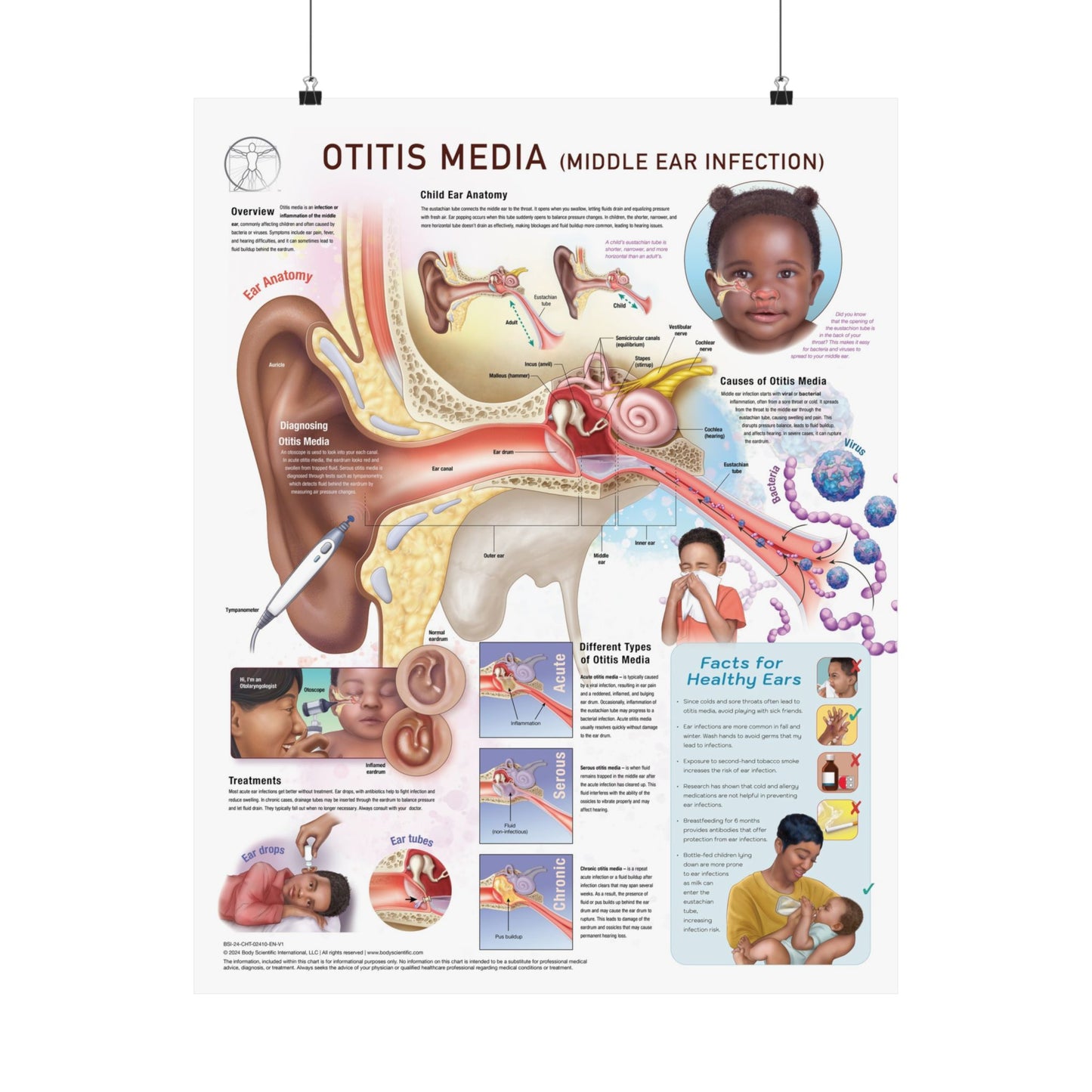 Otitis Media - Poster