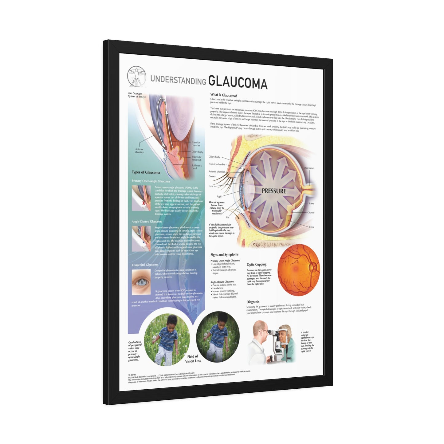 Understanding Glaucoma