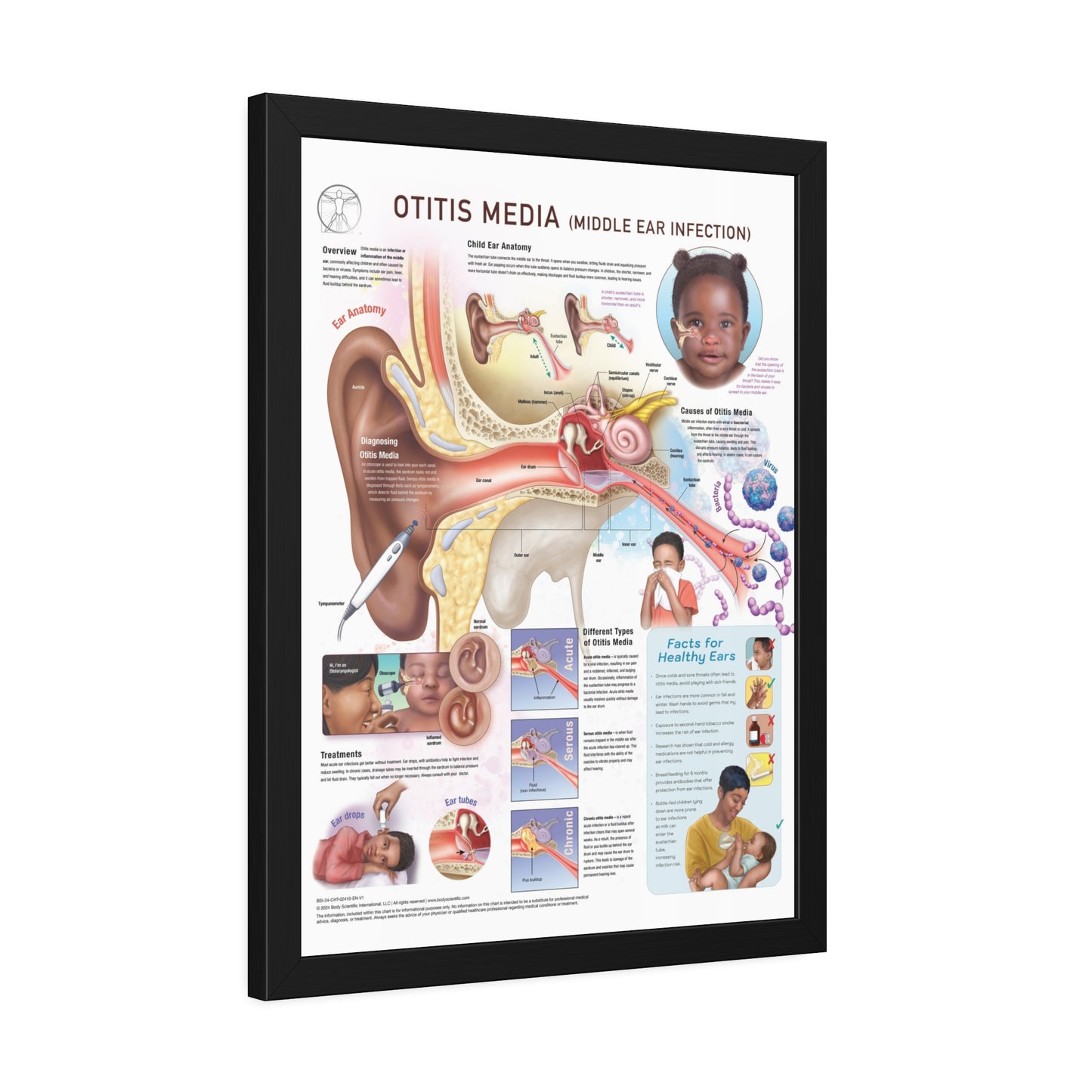 Otitis Media (middle ear infection)