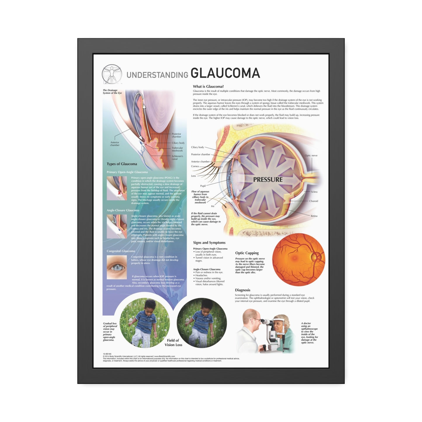 Understanding Glaucoma