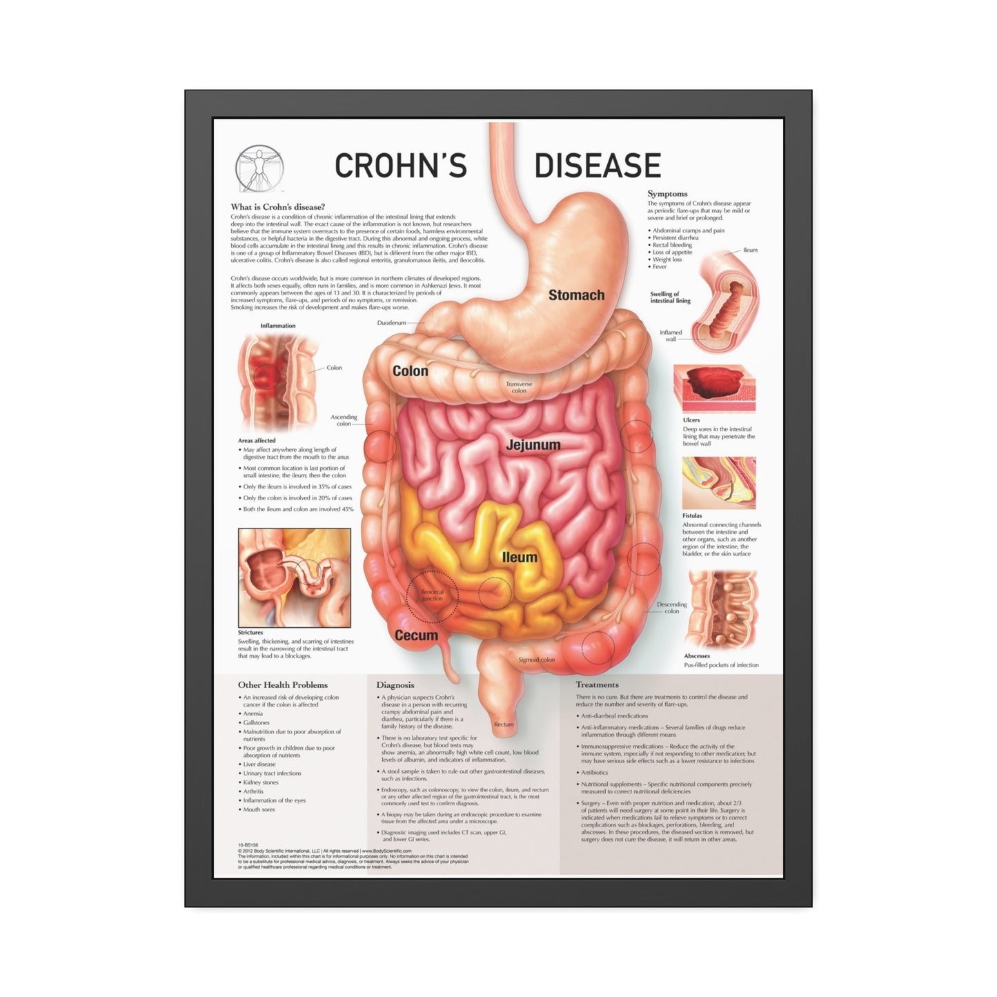 Chron's Disease