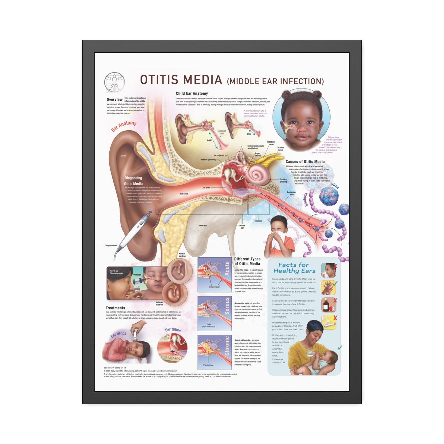 Otitis Media (middle ear infection)