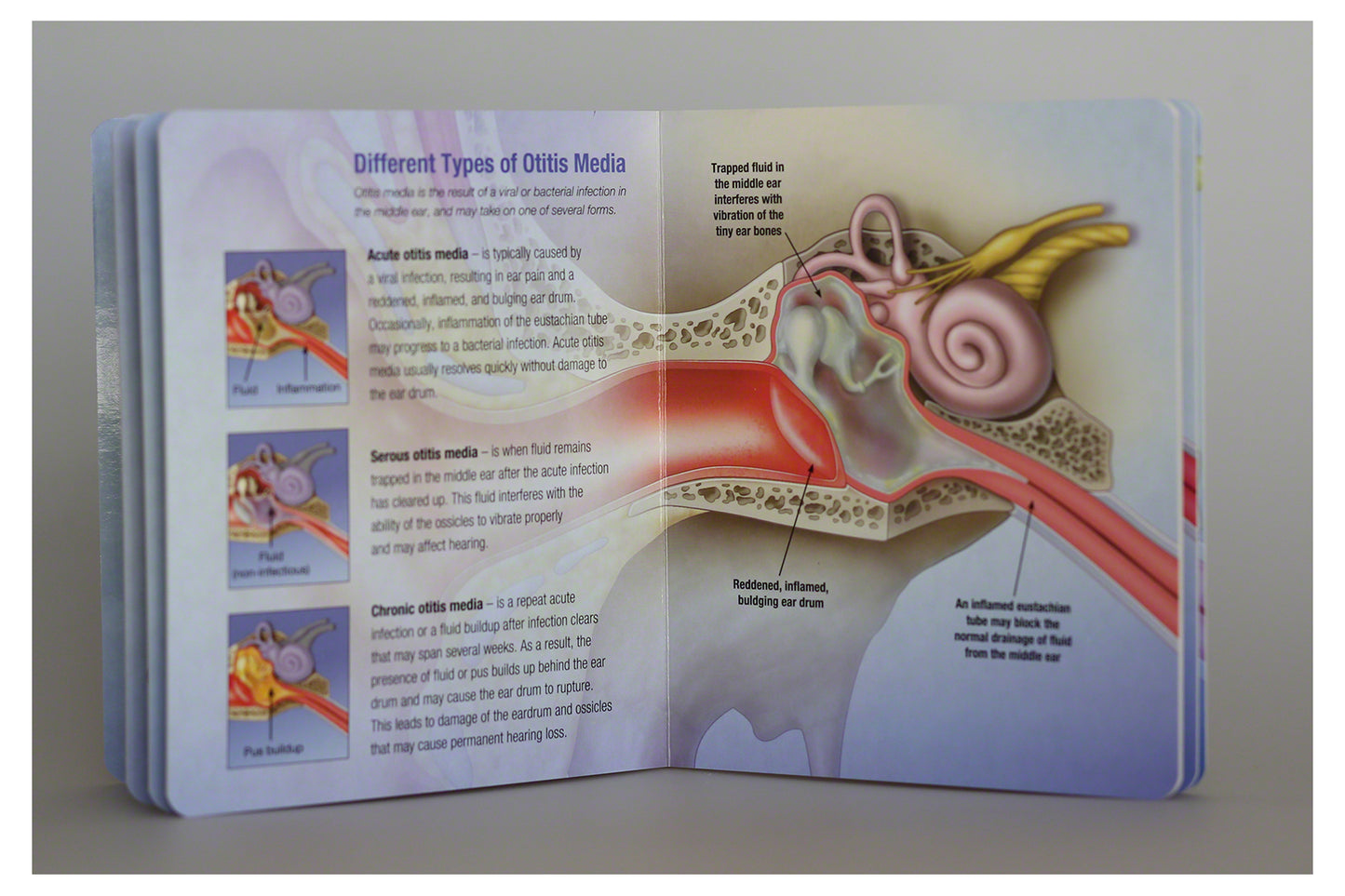 Otitis Media Board Book: Essential Ear Anatomy and Infection Guide