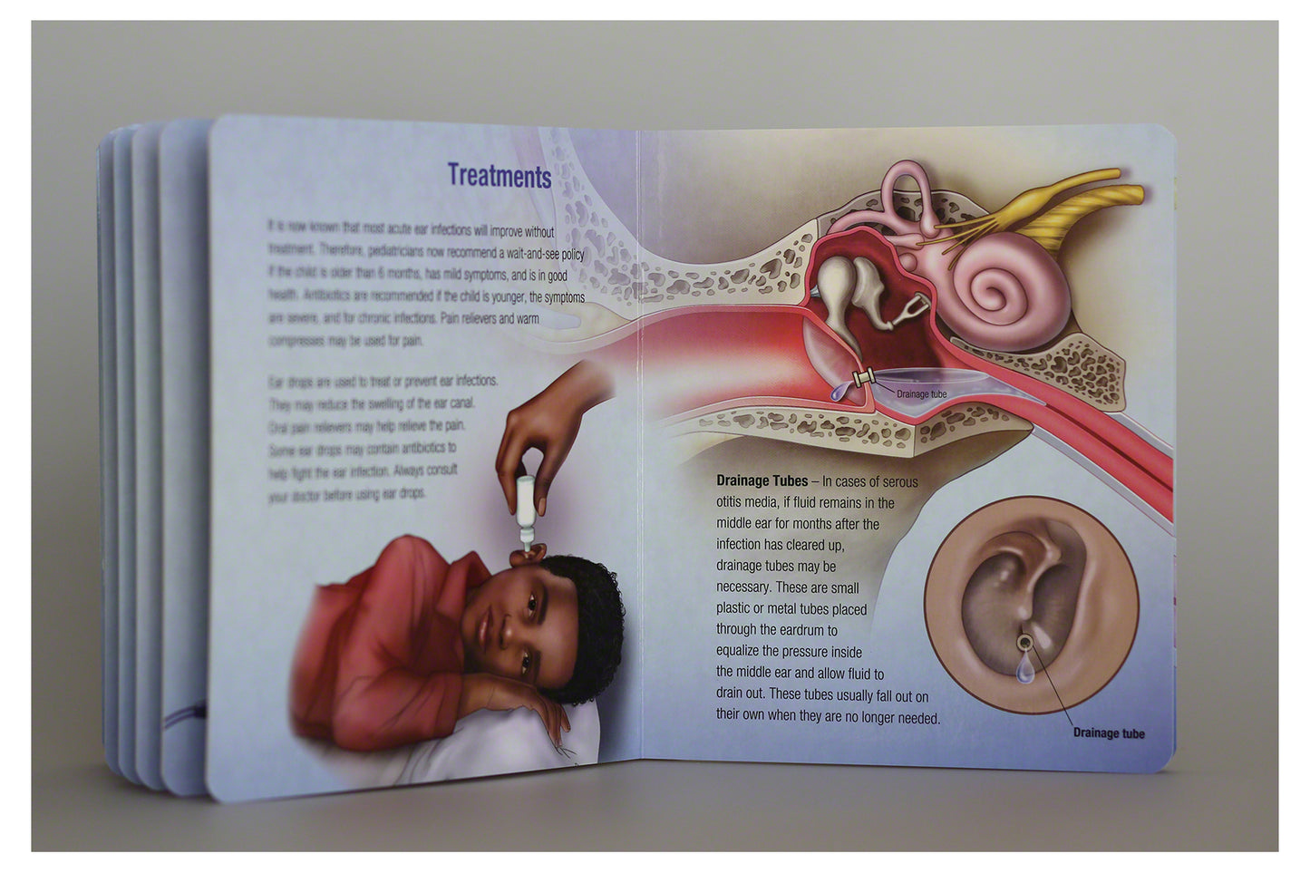 Otitis Media Board Book: Essential Ear Anatomy and Infection Guide