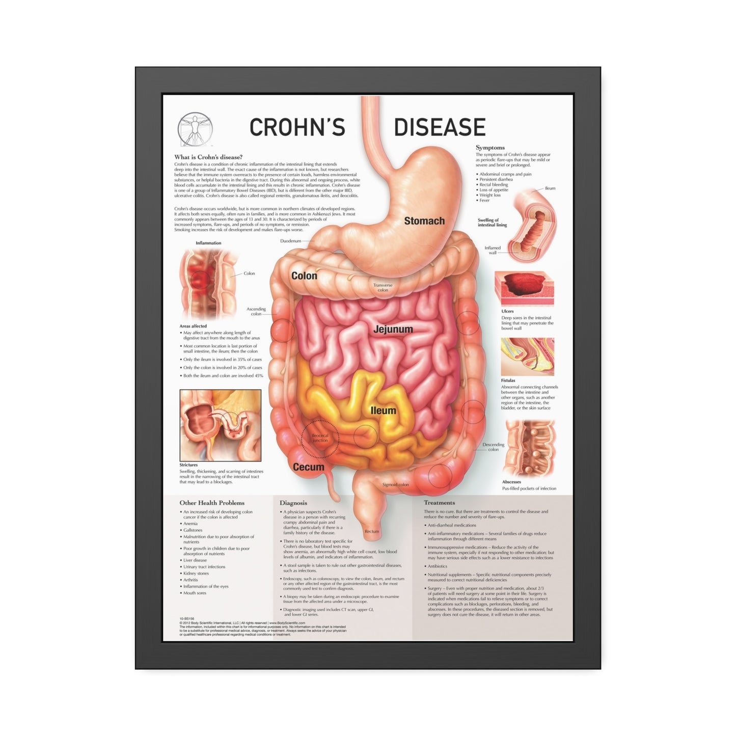 Chron's Disease