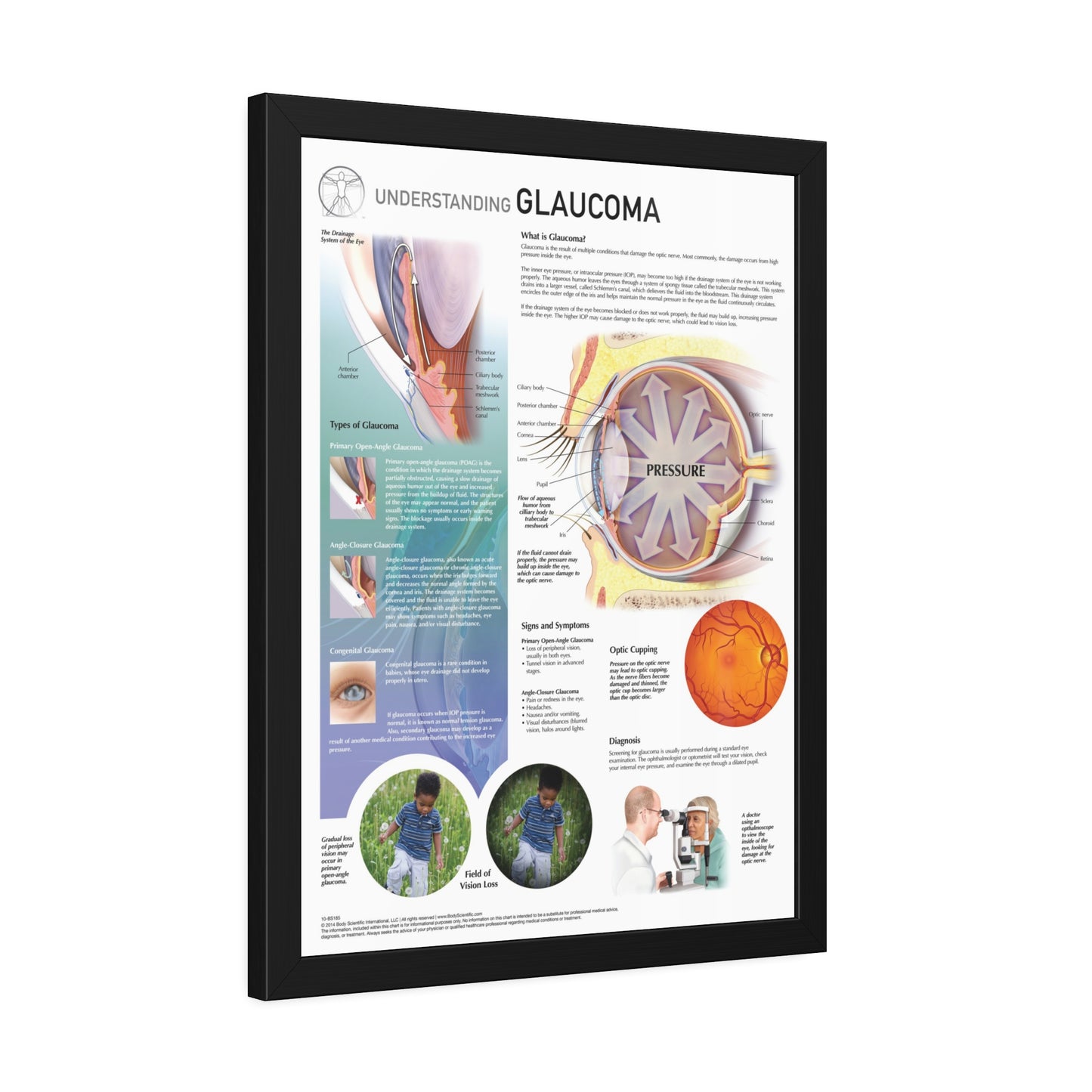 Understanding Glaucoma