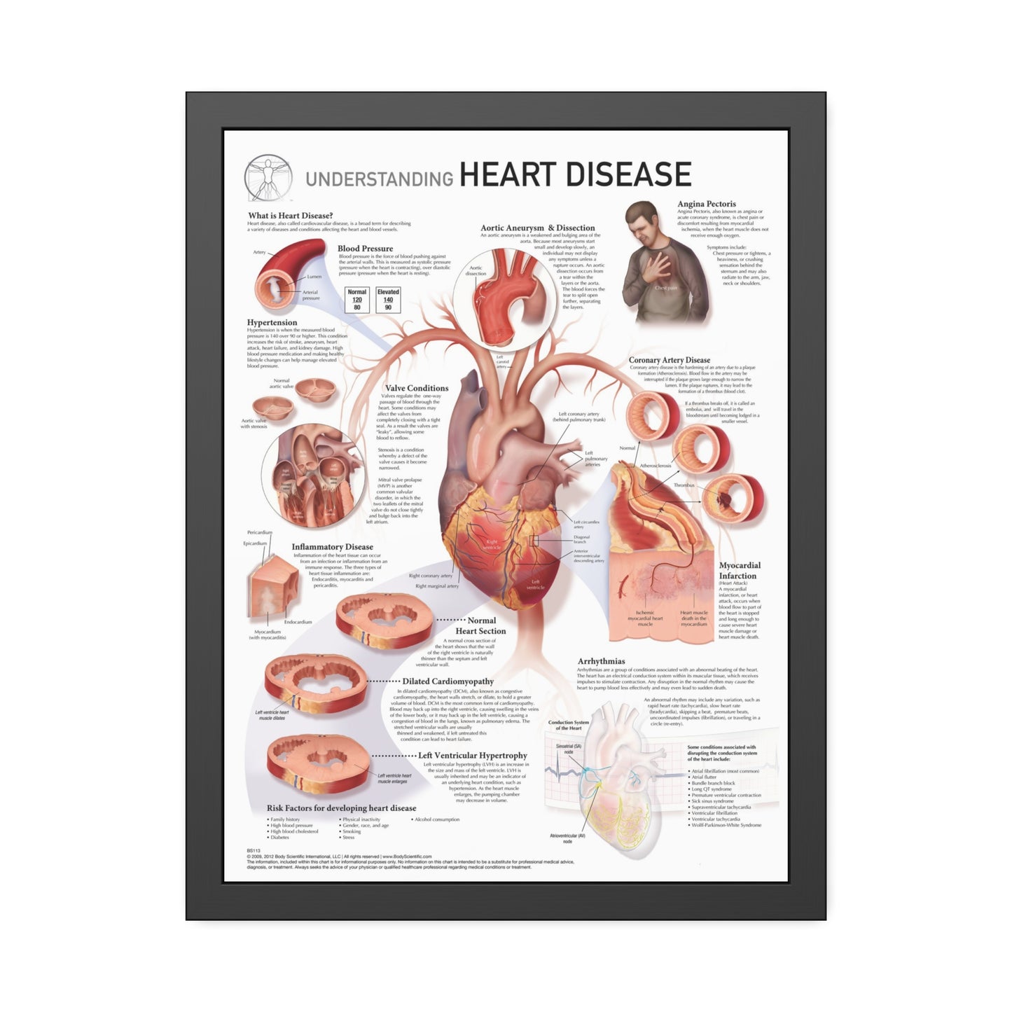 Understanding Heart Disease